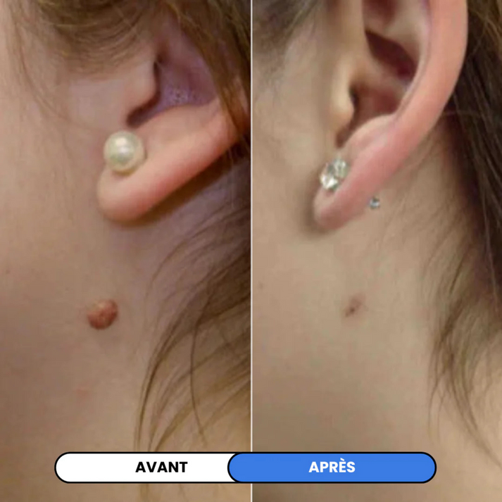 MySkin™ - Kit de Suppression des Acrochordons