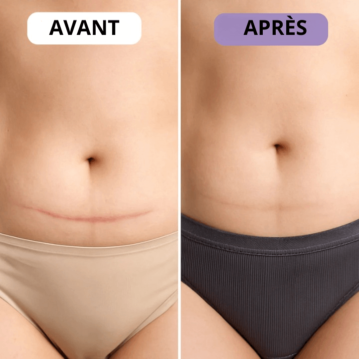 Ondine™ – Patchs anti-rides & cicatrices