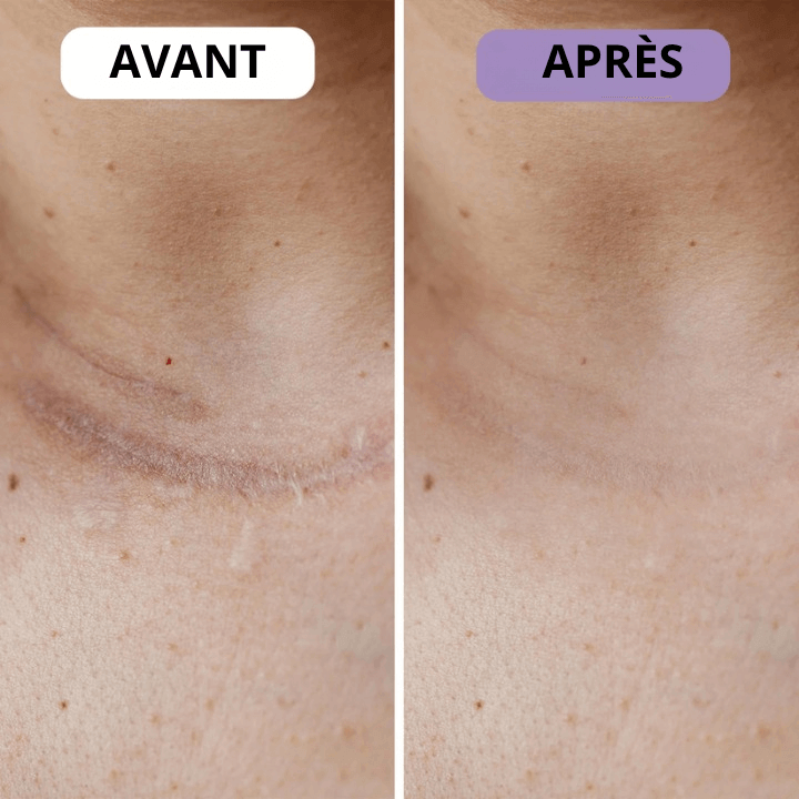 Ondine™ – Patchs anti-rides & cicatrices