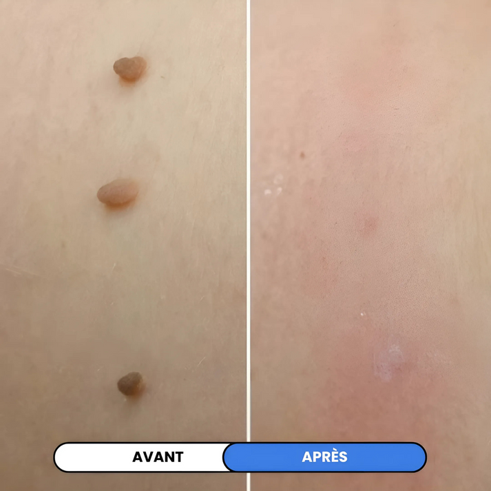 MySkin™ - Kit de Suppression des Acrochordons