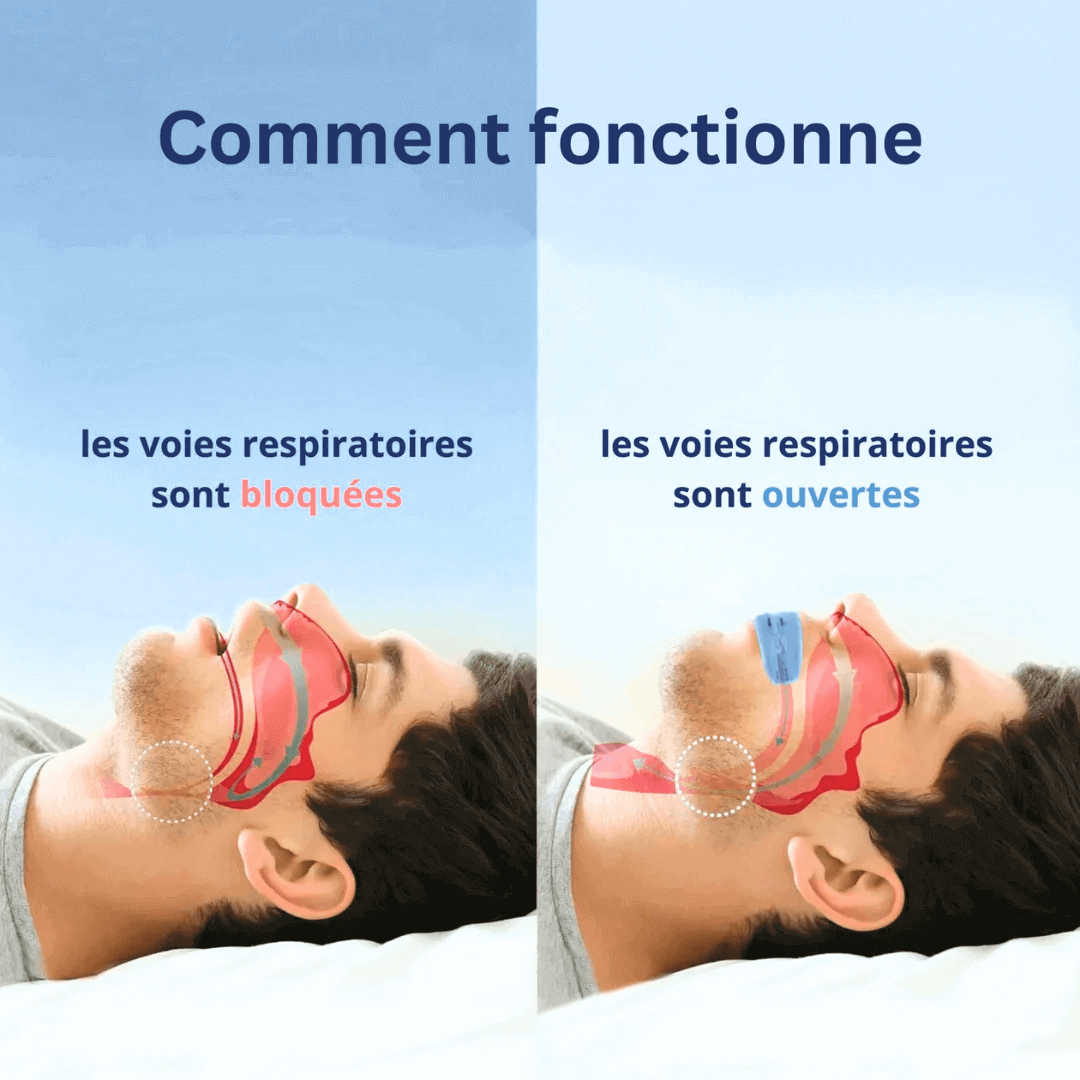 Somnex™ – Orthèse universelle anti-ronflement