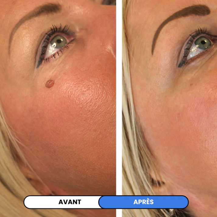MySkin™ - Kit de Suppression des Acrochordons