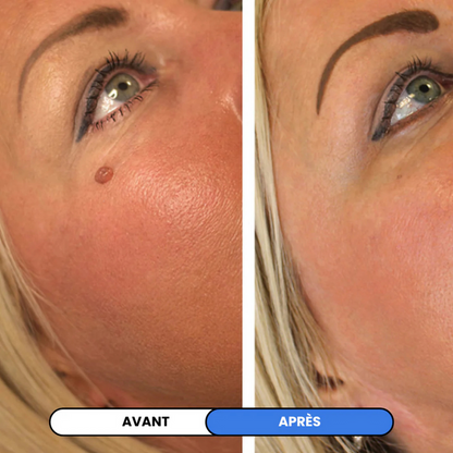 MySkin™ - Kit de Suppression des Acrochordons