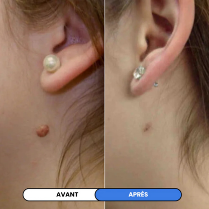 MySkin™ - Kit de Suppression des Acrochordons