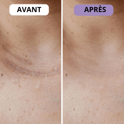 Ondine™ – Patchs anti-rides & cicatrices
