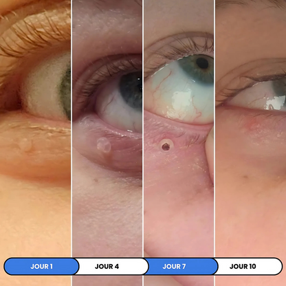 MySkin™ - Kit de Suppression des Acrochordons