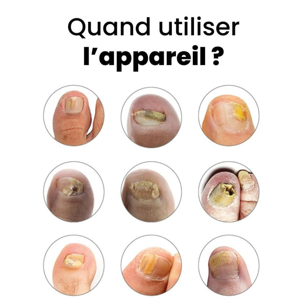 Appareil contre la mycose des ongles OnyMed™