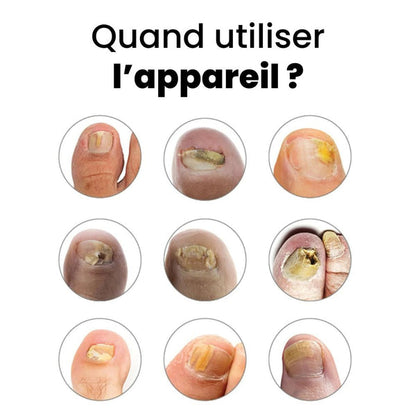 Appareil contre la mycose des ongles OnyMed™