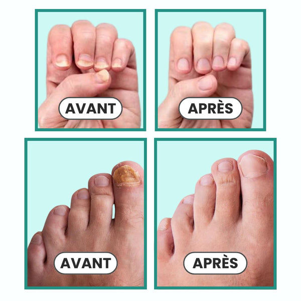 Appareil contre la mycose des ongles OnyMed™
