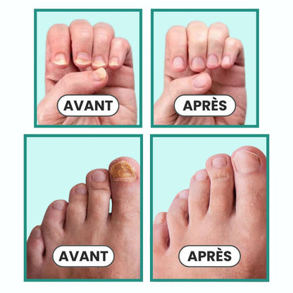 Appareil contre la mycose des ongles OnyMed™