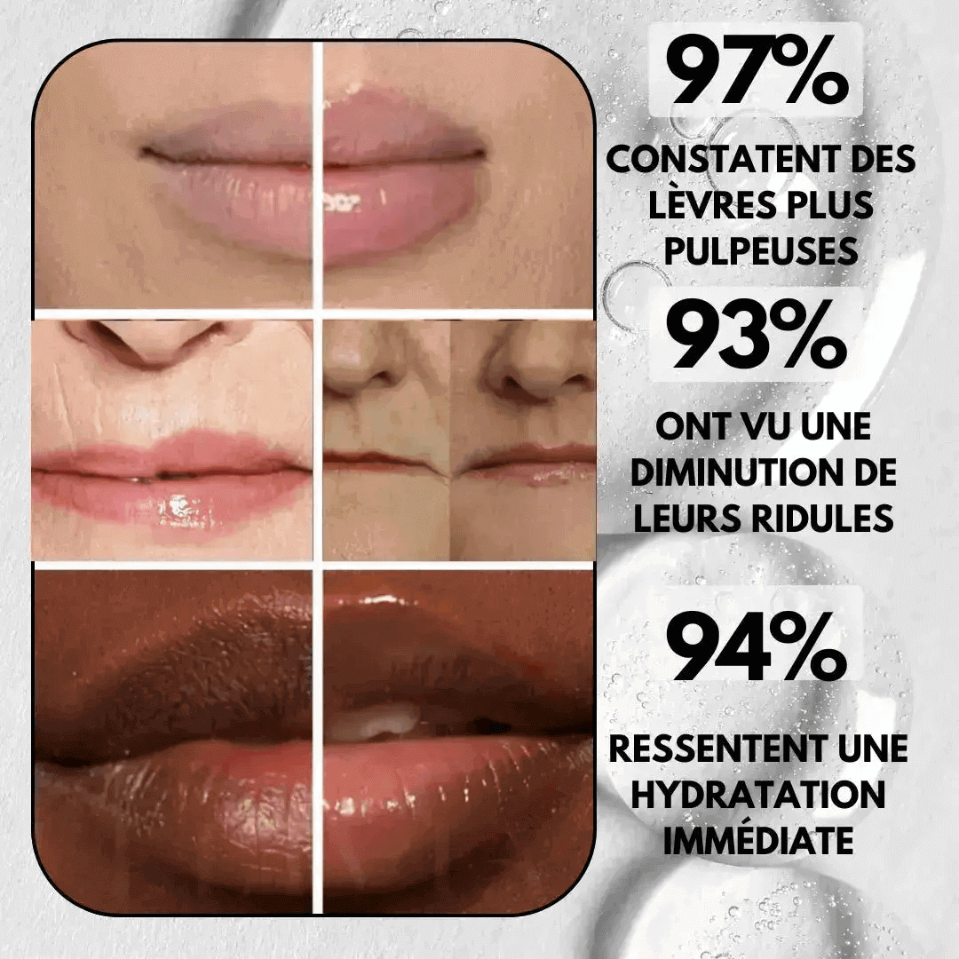 LipRush™ –  Microneedling Lèvres