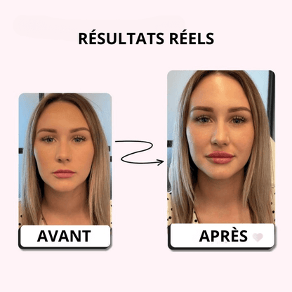 LipRush™ –  Microneedling Lèvres