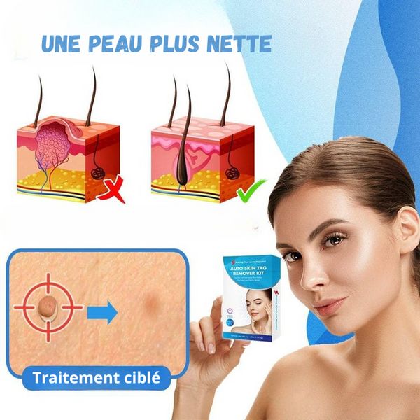 MySkin™ - Kit de Suppression des Acrochordons